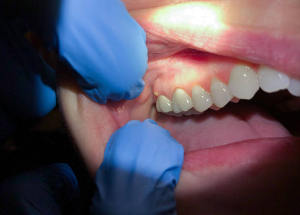 Best Emergency Broken Tooth Repair in Clarkston Heights Vineland, WA